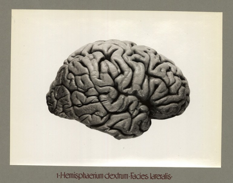 Piłsudski's brain - right hemisphere, lateral part; source: Mózg Piłsudskiego at Polona / www.polona.pl